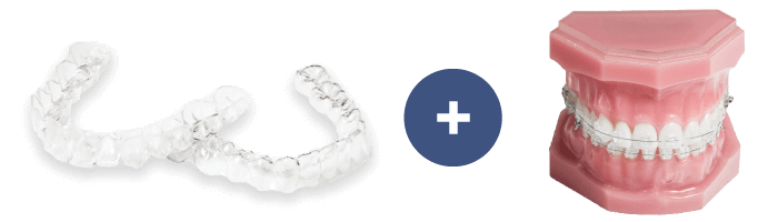 マウスピース+ワイヤー